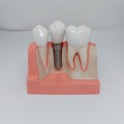 Maxi Implantat/Bro Studiemodel 